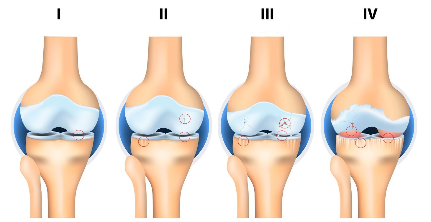 Как лечить гонартроз коленного сустава 1 степени. Стадии остеоартроза коленного сустава. Деформирующий остеоартроз стадии. Доа коленного сустава степени.
